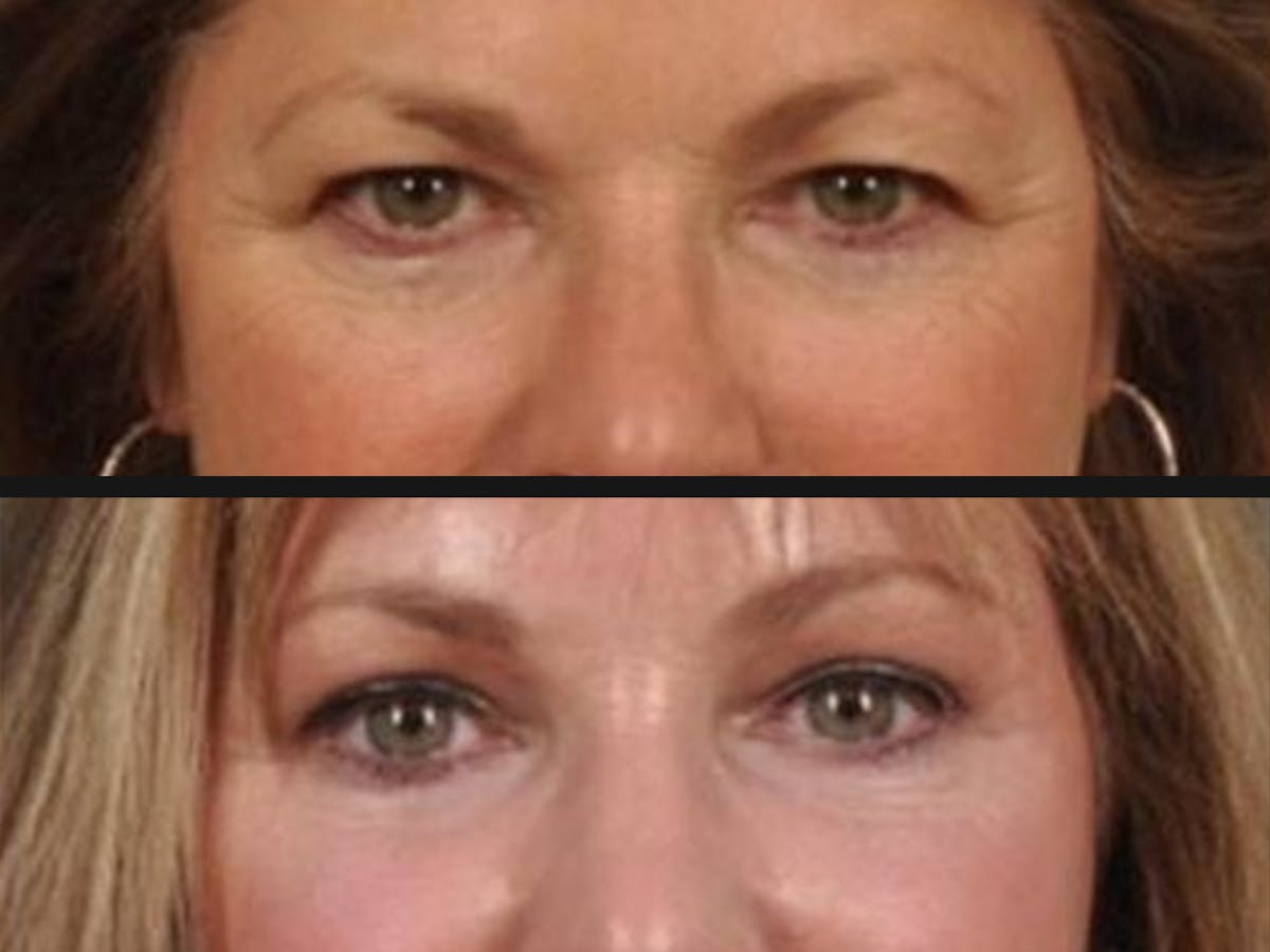 Blepharoplasty Before & After Gallery - Patient 334603 - Image 2