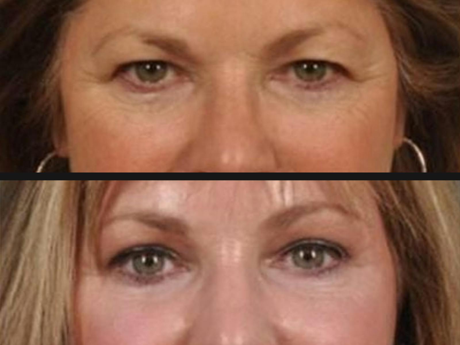 Blepharoplasty Before & After Gallery - Patient 334603 - Image 2