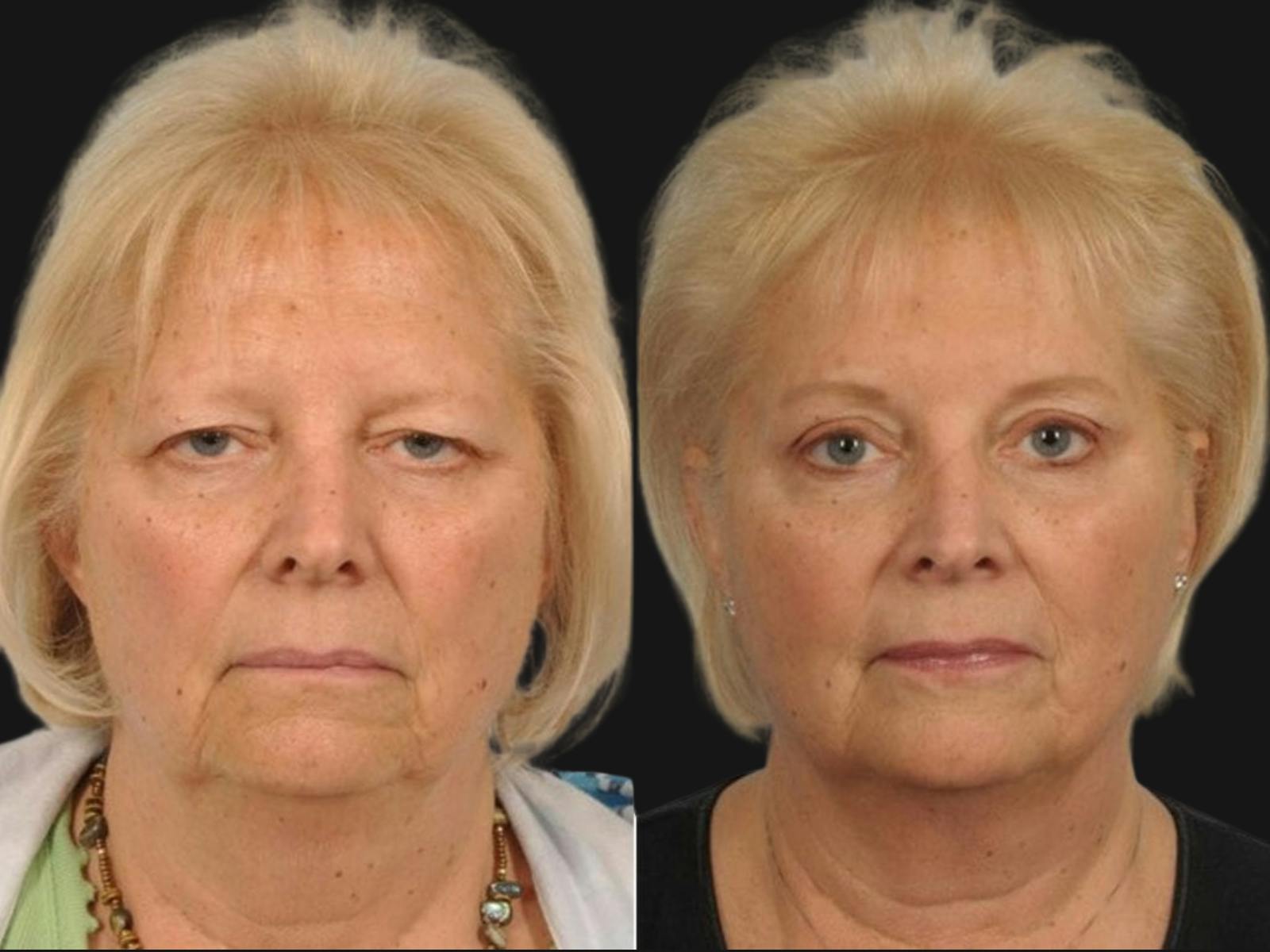 Blepharoplasty Before & After Gallery - Patient 303465 - Image 1