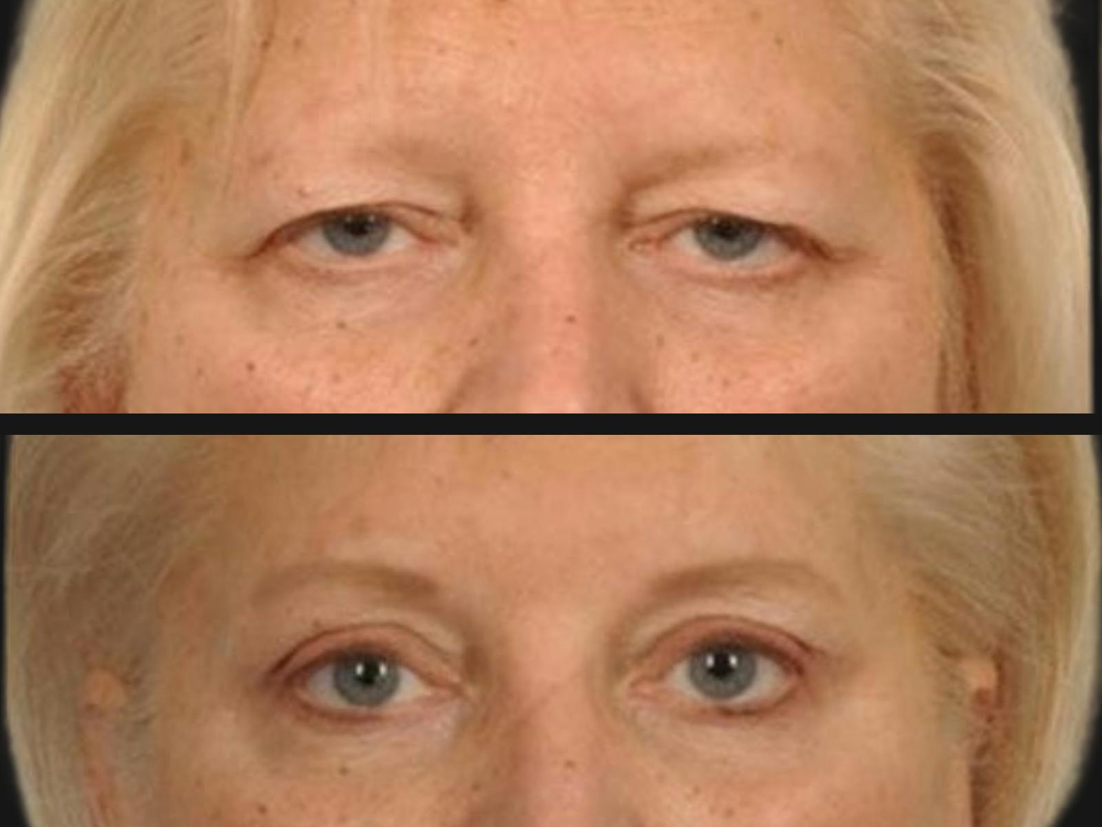 Blepharoplasty Before & After Gallery - Patient 303465 - Image 2