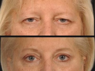 Blepharoplasty Before & After Gallery - Patient 303465 - Image 2