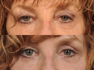 Festoon Surgery Before & After Gallery - Patient 639938 - Image 2