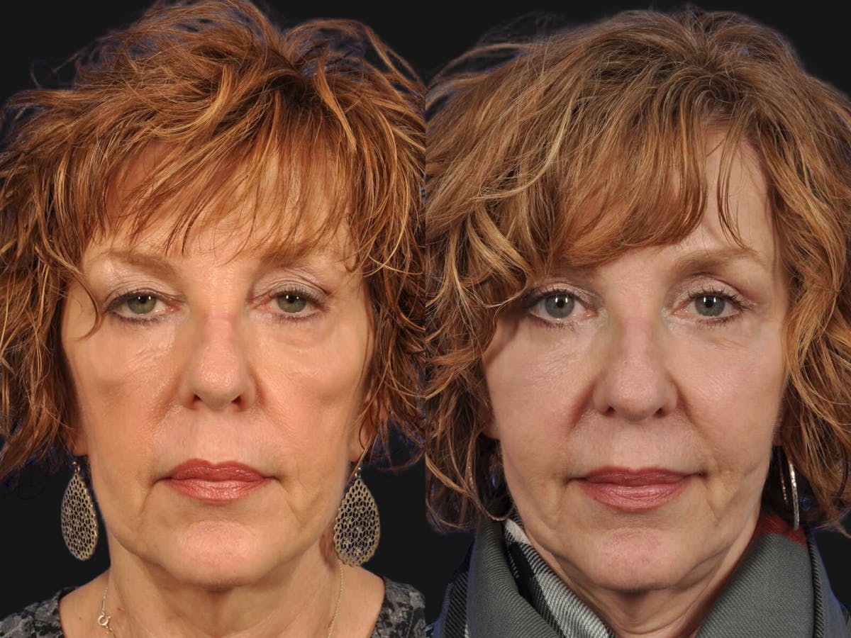 Festoon Surgery Before & After Gallery - Patient 639938 - Image 1