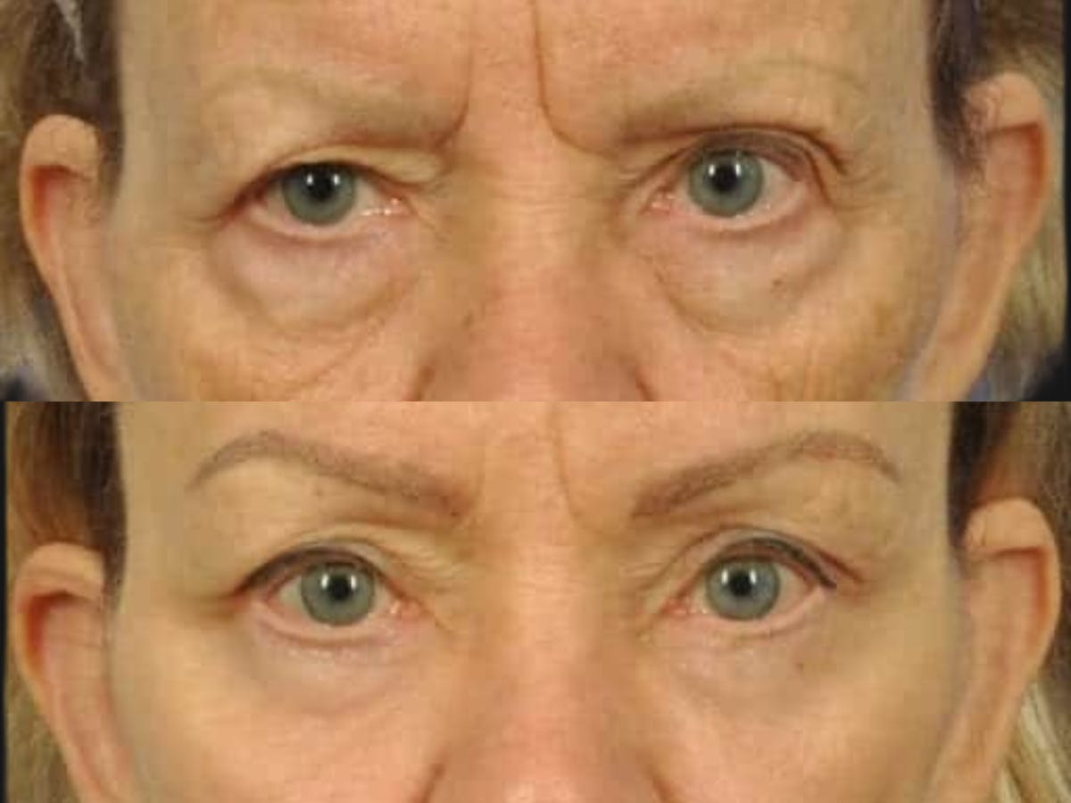 Festoon Surgery Before & After Gallery - Patient 258876 - Image 2