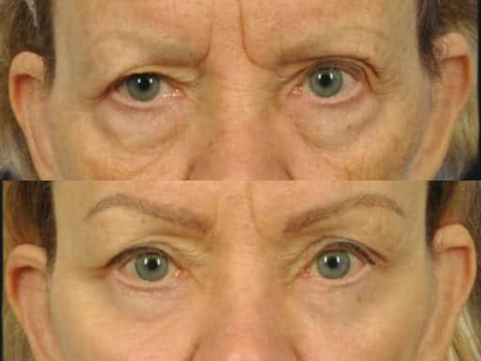 Festoon Surgery Before & After Gallery - Patient 258876 - Image 2