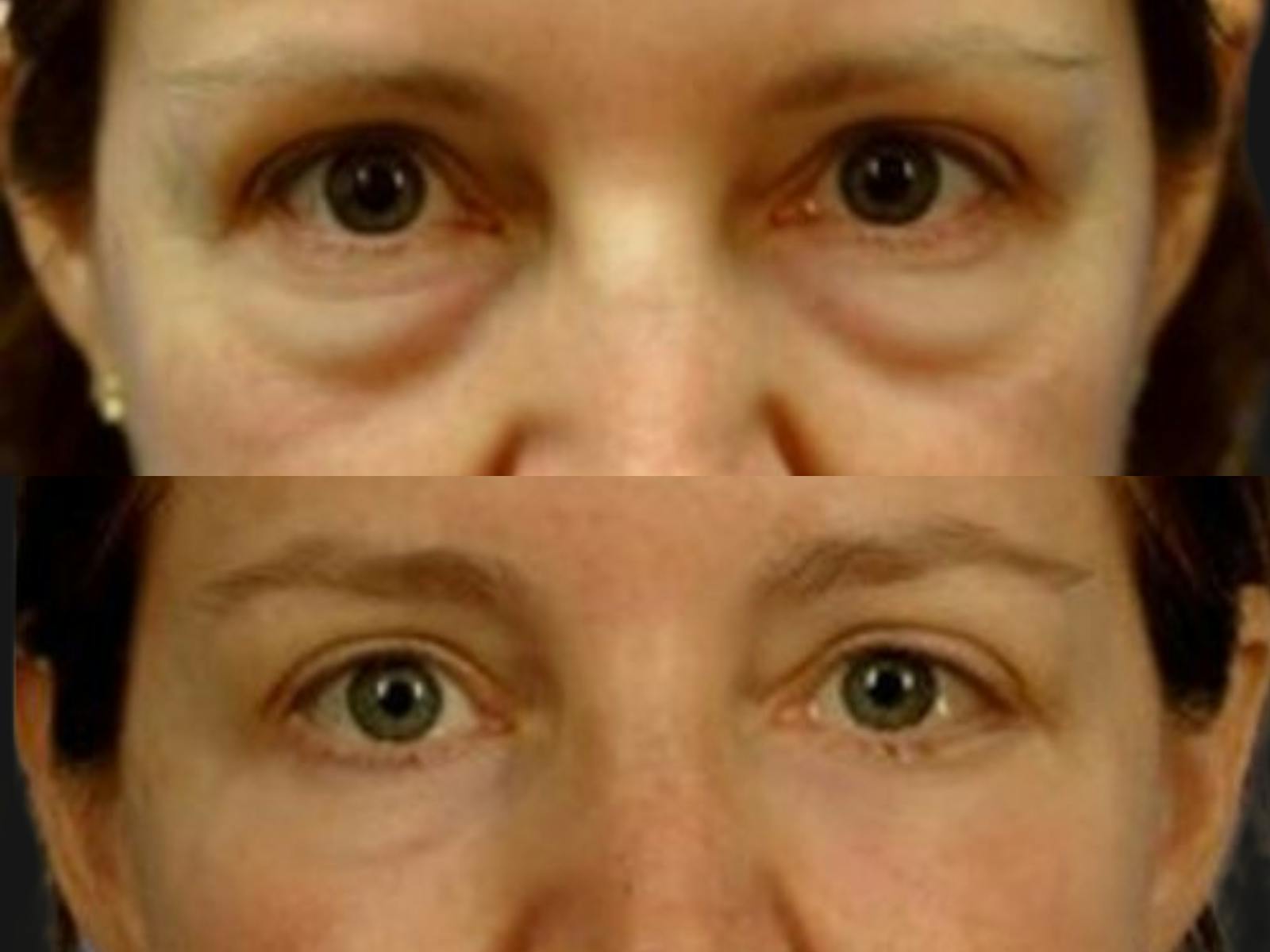 Festoon Surgery Before & After Gallery - Patient 138072 - Image 2