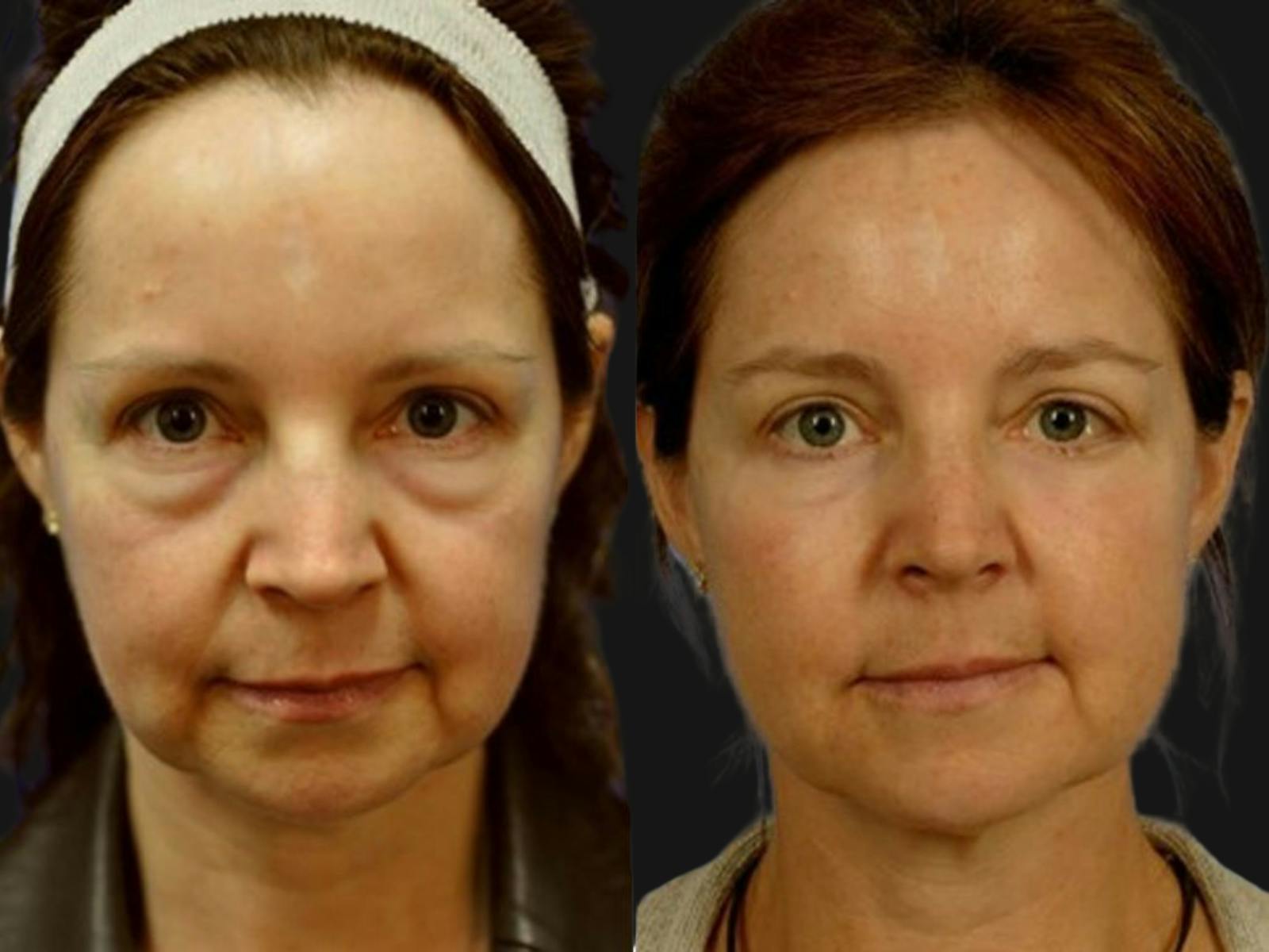 Festoon Surgery Before & After Gallery - Patient 138072 - Image 1