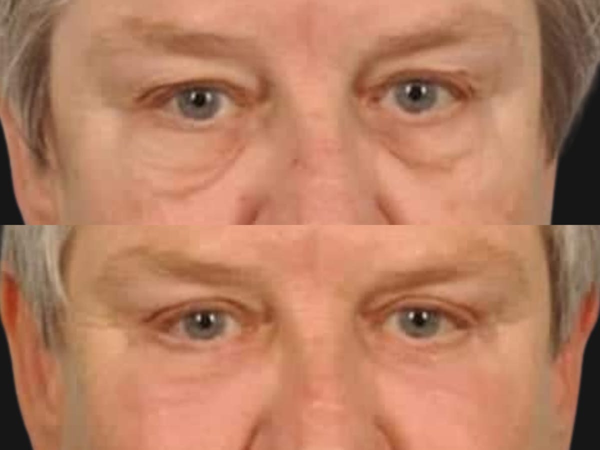 Festoon Surgery Before & After Gallery - Patient 104342 - Image 2