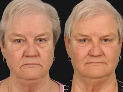 Festoon Surgery Before & After Gallery - Patient 104342 - Image 1