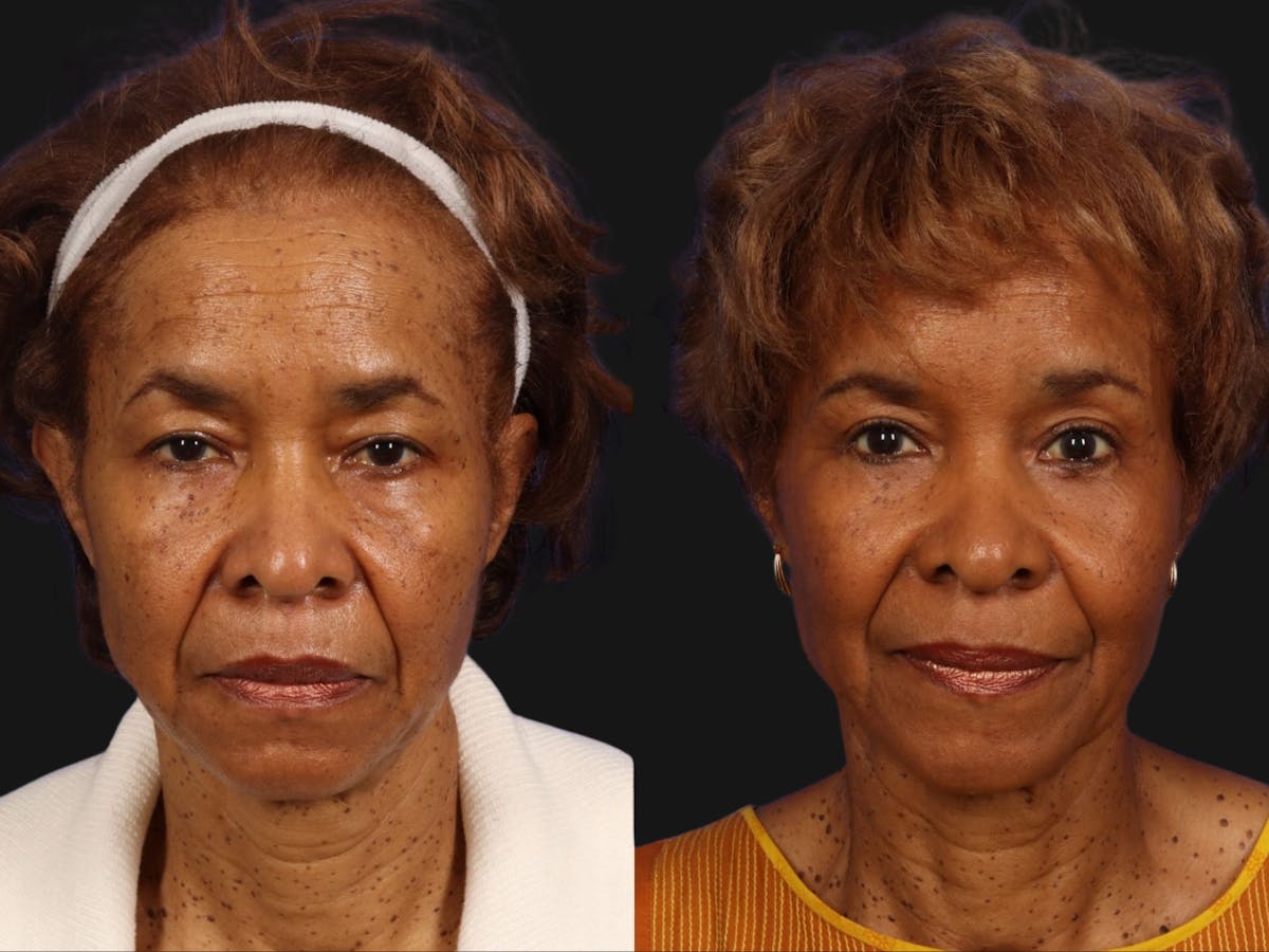 Festoon Surgery Before & After Gallery - Patient 367317 - Image 1