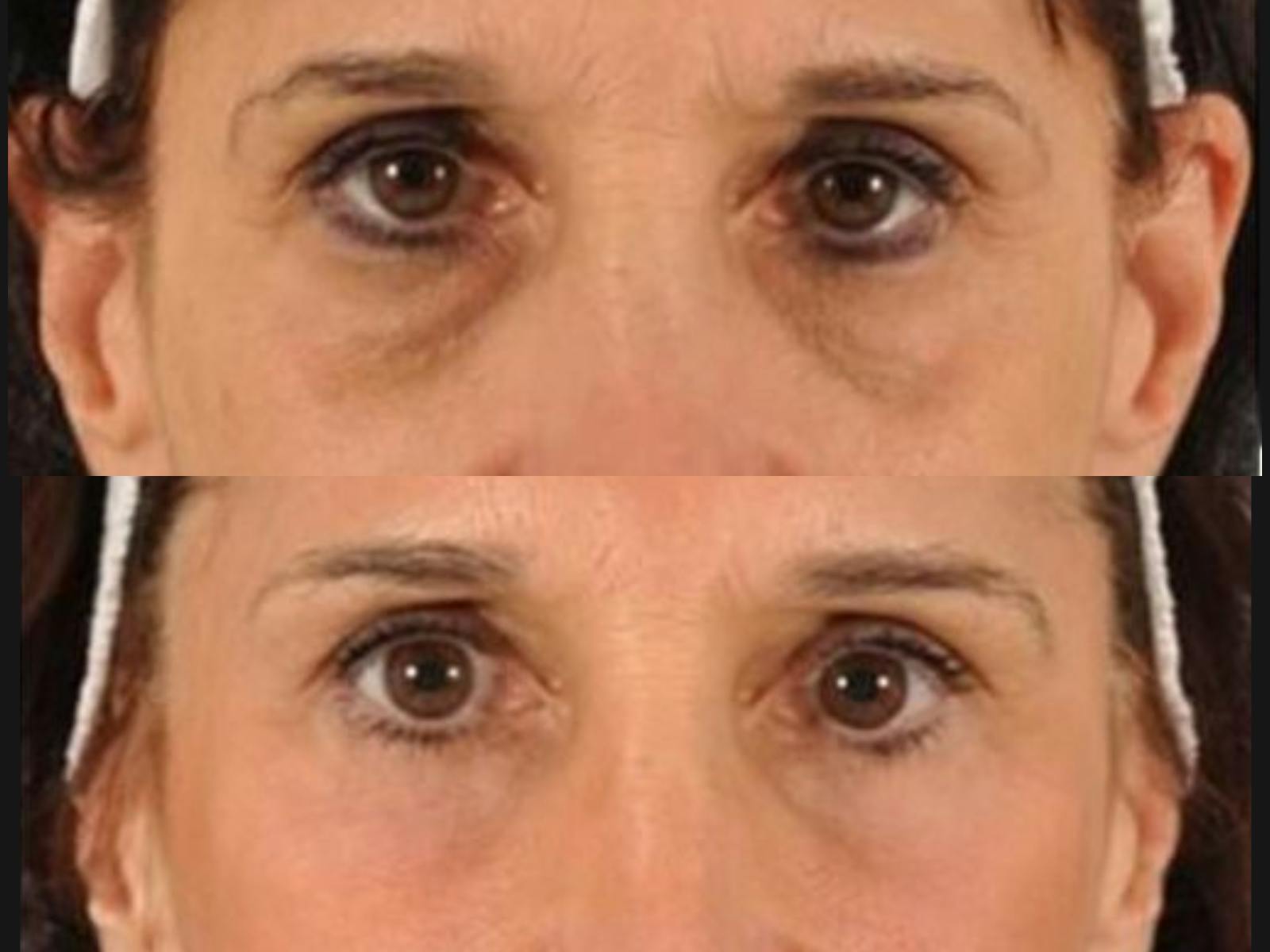 Festoon Surgery Before & After Gallery - Patient 221036 - Image 2