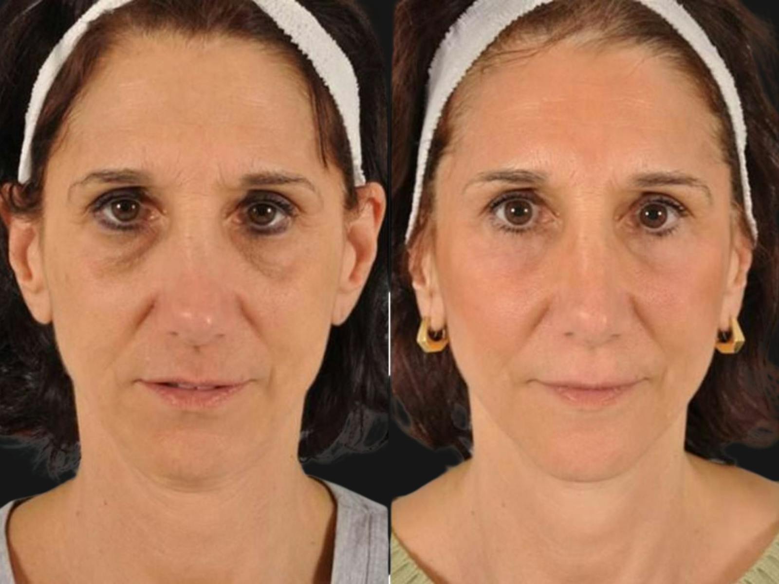 Festoon Surgery Before & After Gallery - Patient 221036 - Image 1