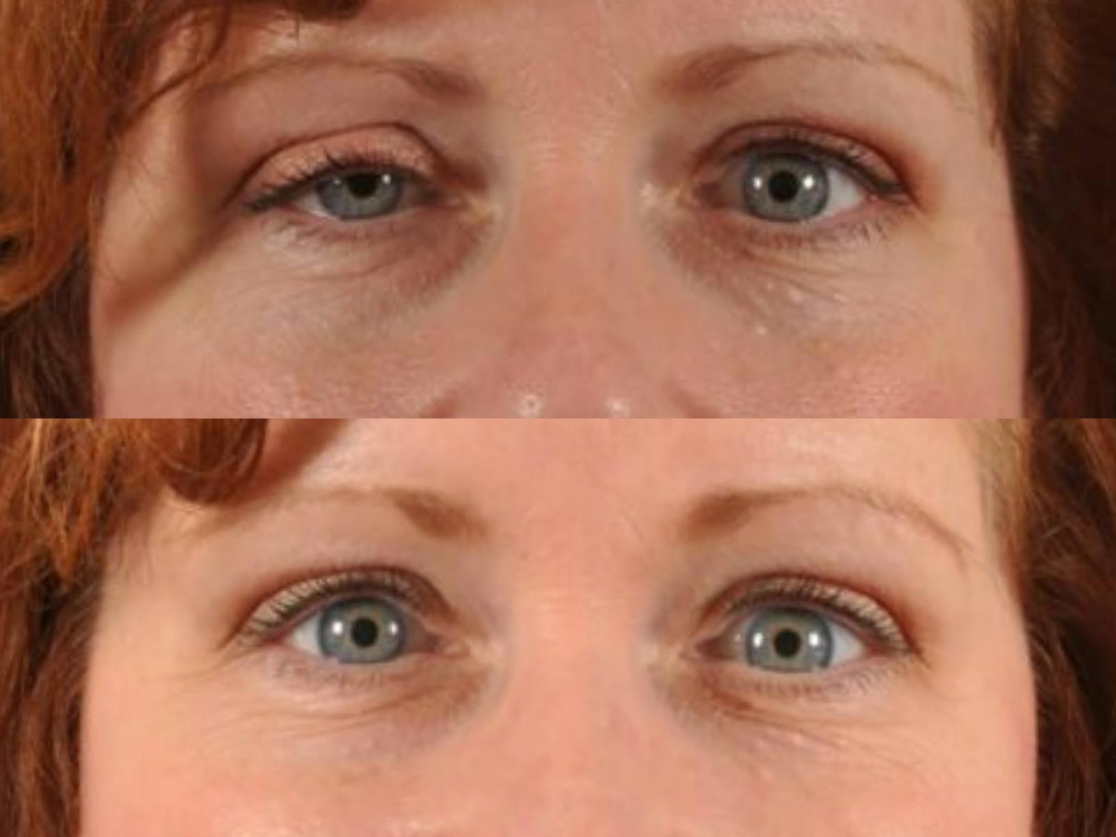 Droopy Eyelids – Ptosis Before & After Gallery - Patient 225557 - Image 2