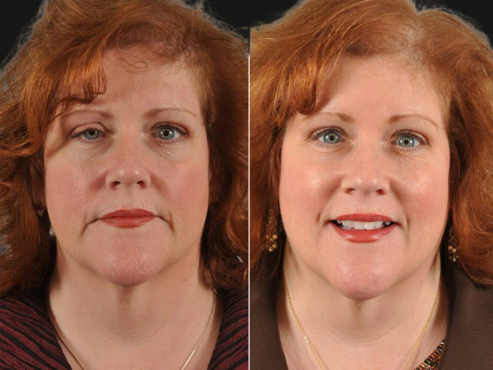 Droopy Eyelids – Ptosis Before & After Gallery - Patient 225557 - Image 1