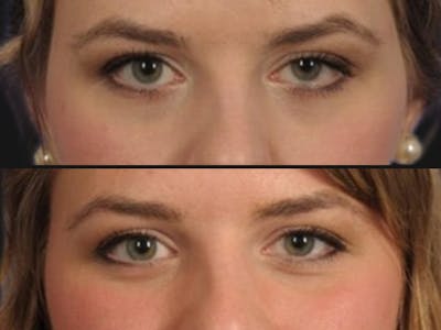 Droopy Eyelids – Ptosis Before & After Gallery - Patient 213284 - Image 2
