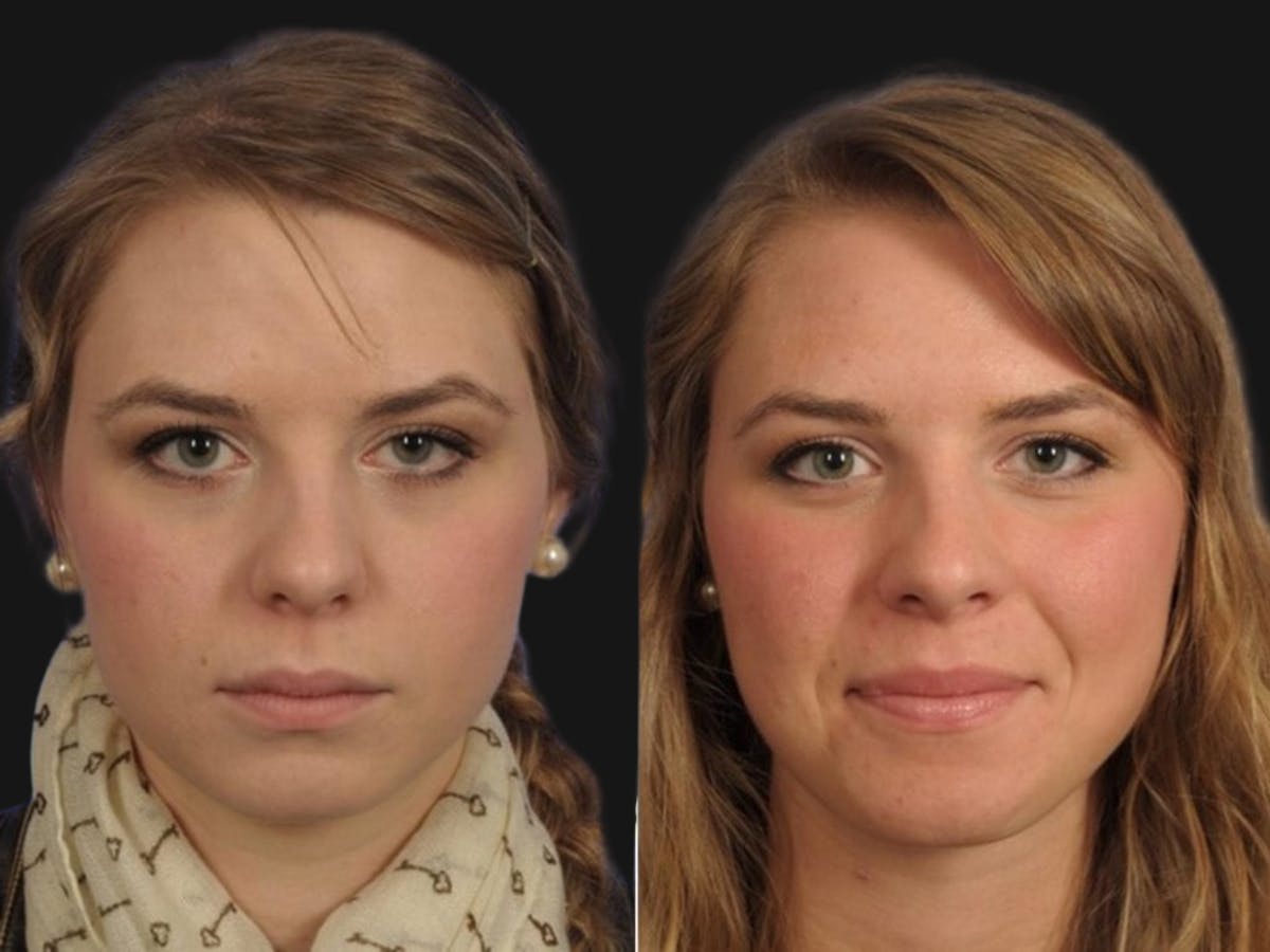 Droopy Eyelids – Ptosis Before & After Gallery - Patient 213284 - Image 1