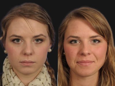 Droopy Eyelids – Ptosis Before & After Gallery - Patient 213284 - Image 1