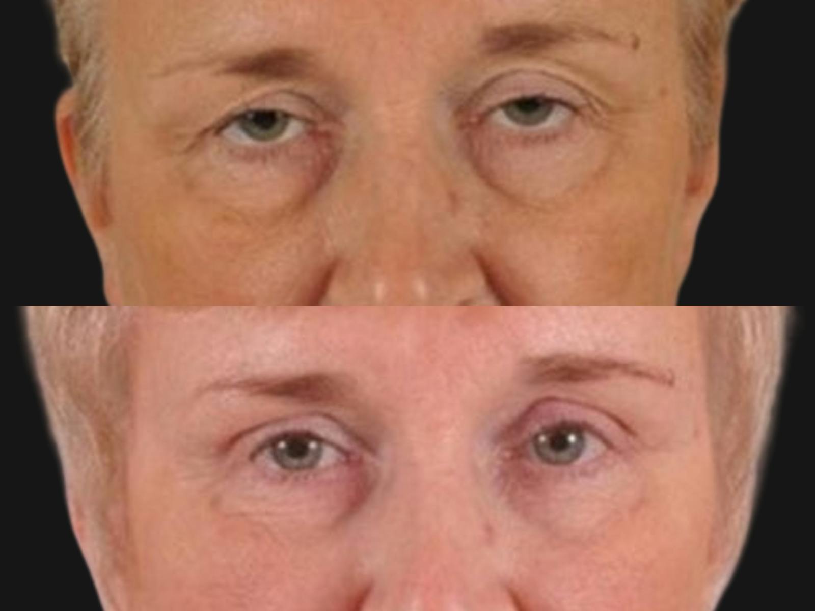 Droopy Eyelids – Ptosis Before & After Gallery - Patient 349525 - Image 2
