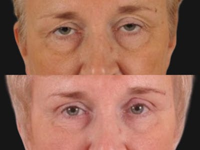 Droopy Eyelids – Ptosis Before & After Gallery - Patient 349525 - Image 2