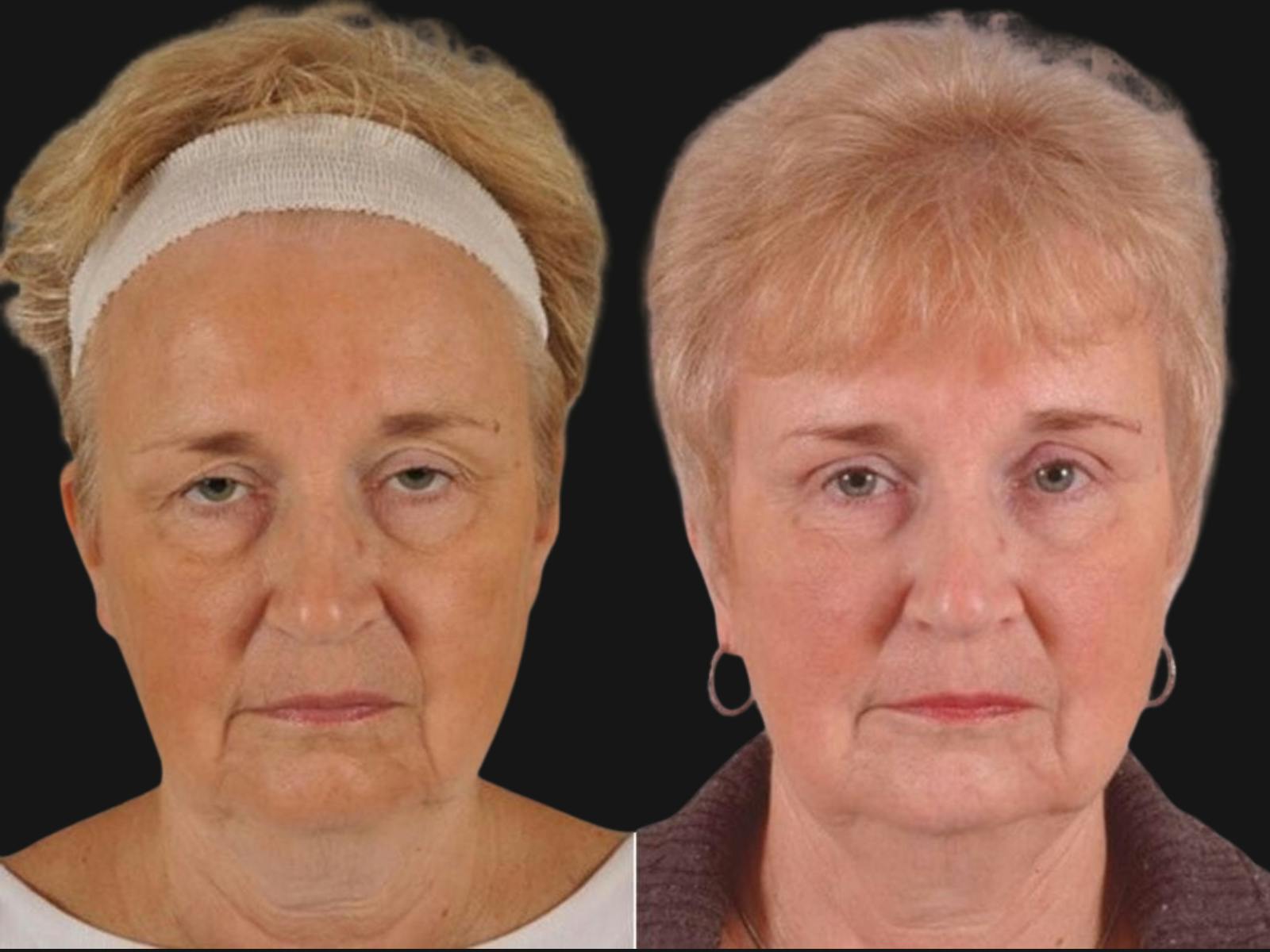Droopy Eyelids – Ptosis Before & After Gallery - Patient 349525 - Image 1
