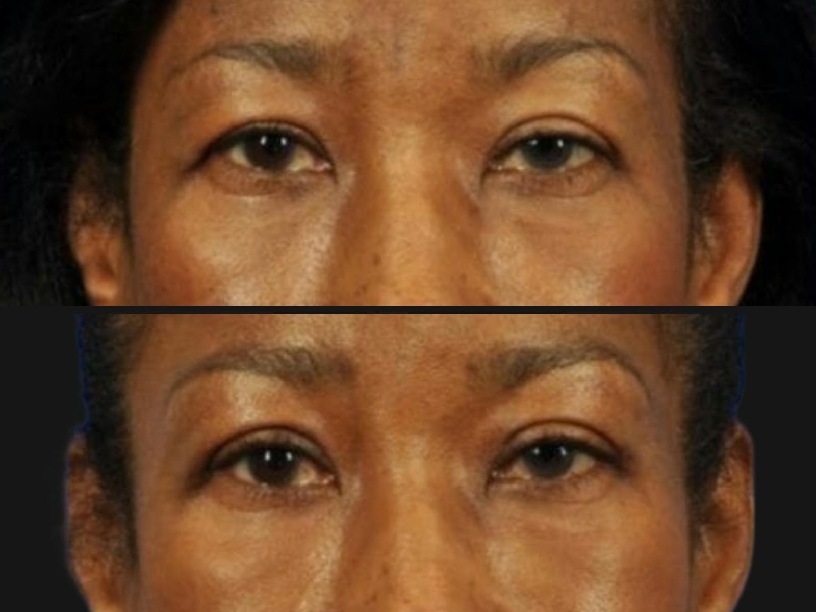Droopy Eyelids – Ptosis Before & After Gallery - Patient 659674 - Image 2