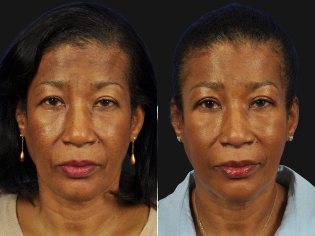 Droopy Eyelids – Ptosis Before & After Gallery - Patient 659674 - Image 1
