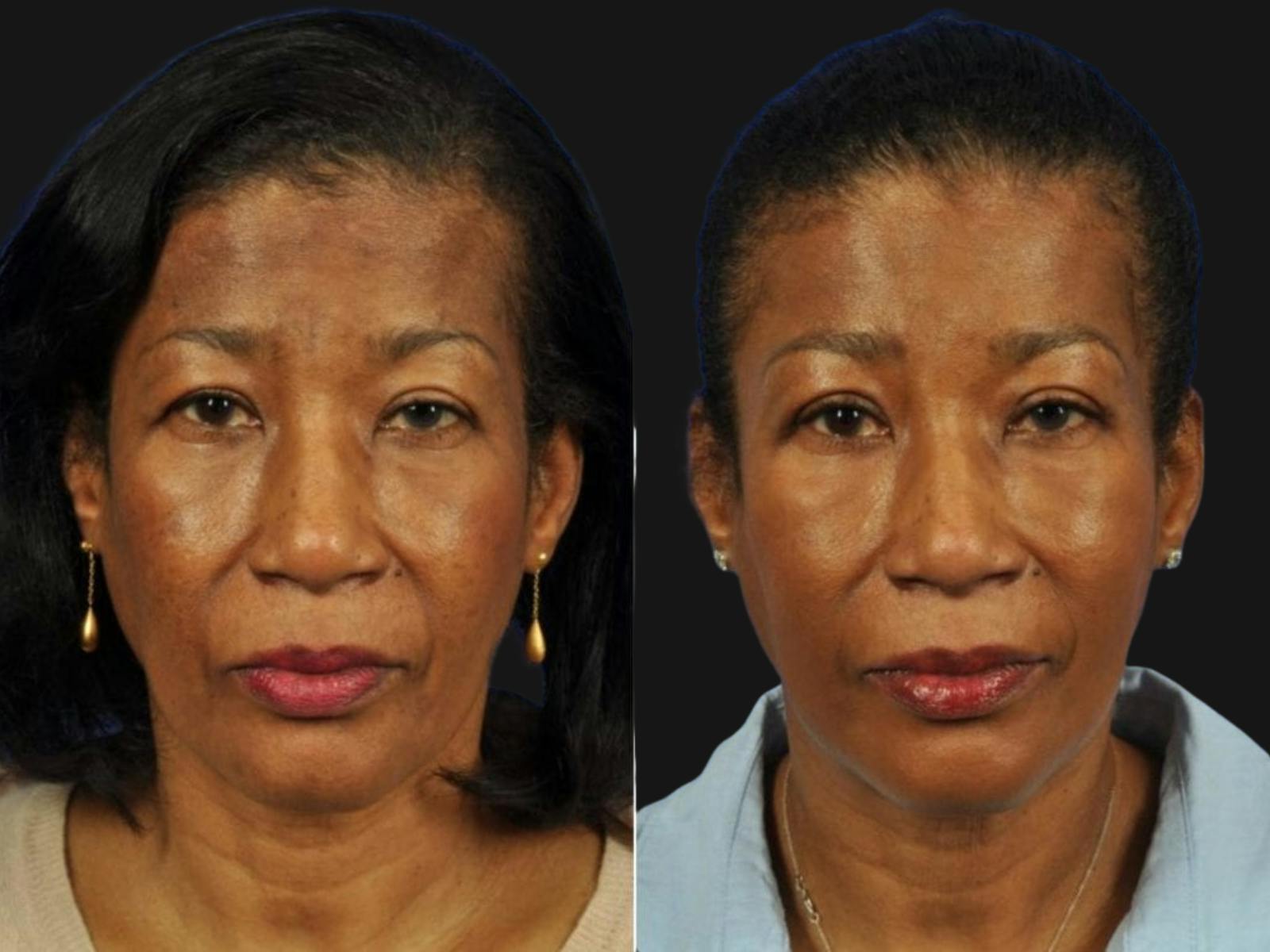 Droopy Eyelids – Ptosis Before & After Gallery - Patient 659674 - Image 1