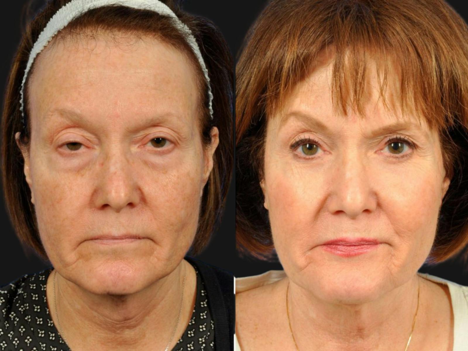 Droopy Eyelids – Ptosis Before & After Gallery - Patient 264574 - Image 1