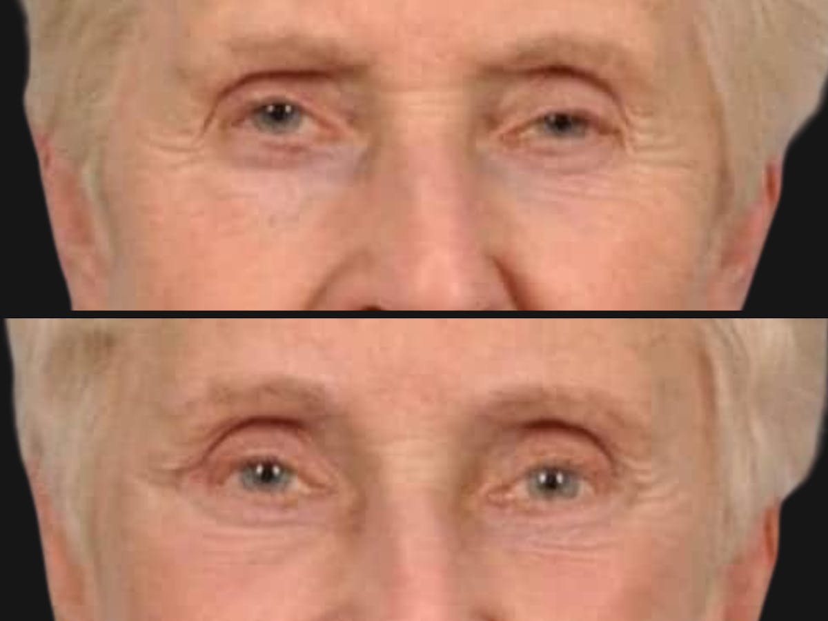 Droopy Eyelids – Ptosis Before & After Gallery - Patient 106912 - Image 2