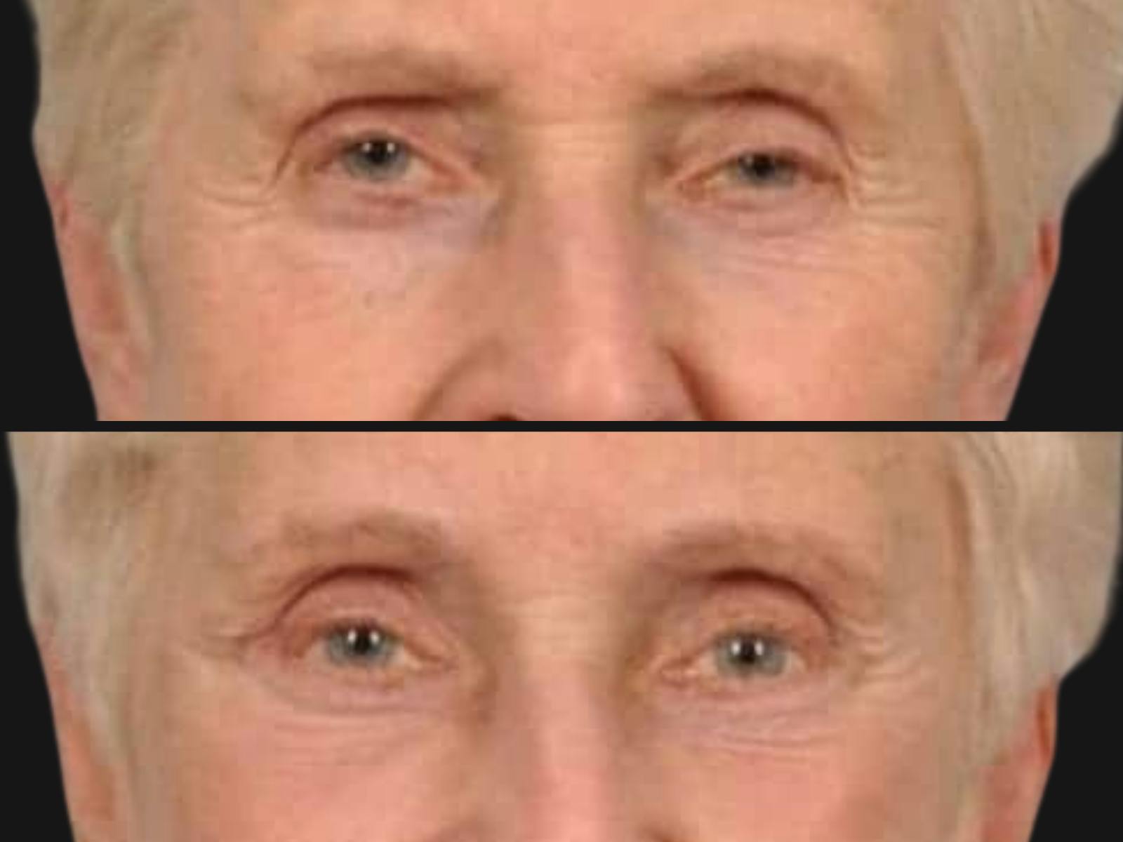 Droopy Eyelids – Ptosis Before & After Gallery - Patient 106912 - Image 2