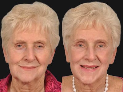 Droopy Eyelids – Ptosis Before & After Gallery - Patient 106912 - Image 1