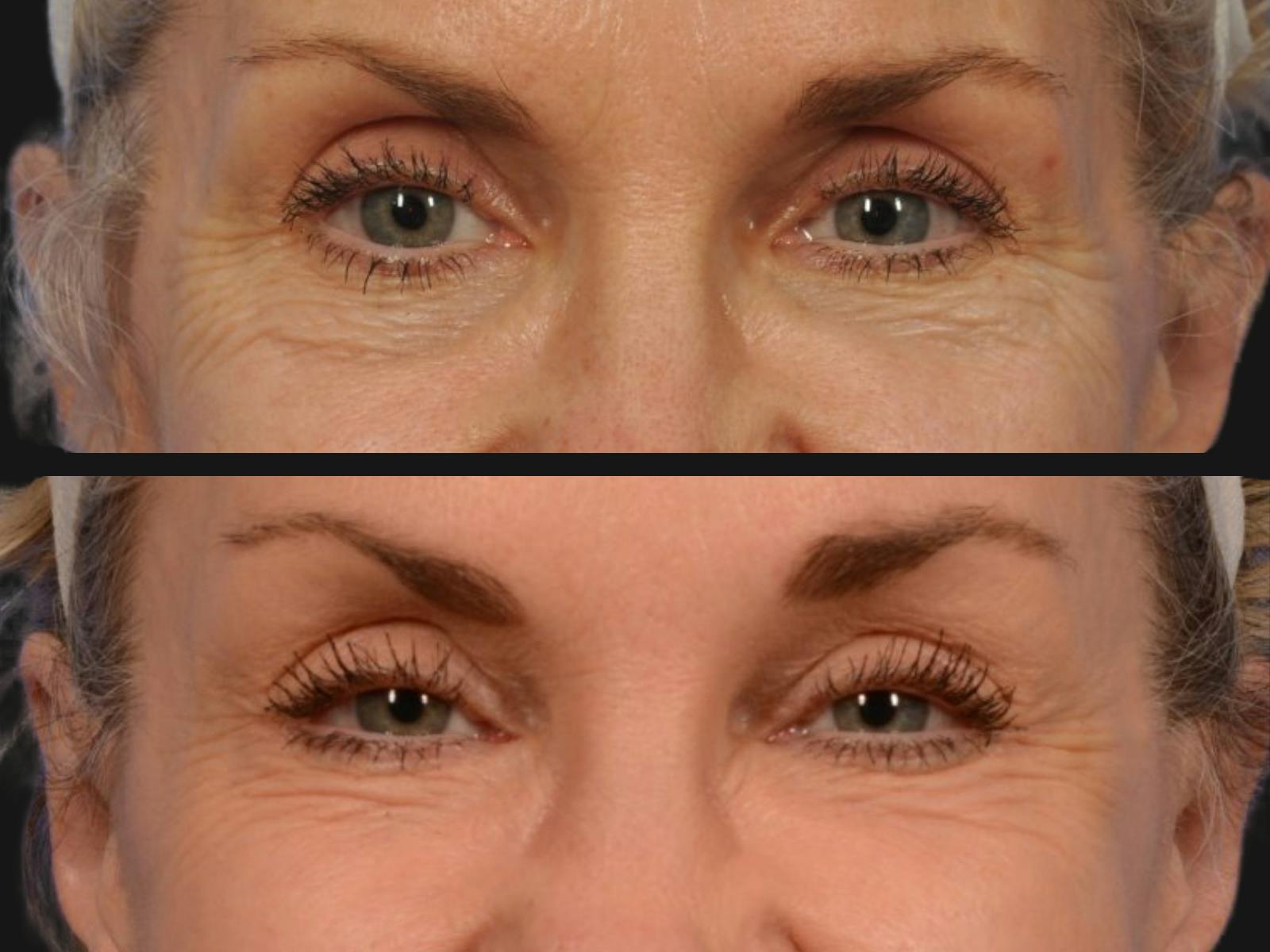 Blepharoplasty Before & After Gallery - Patient 366030 - Image 2