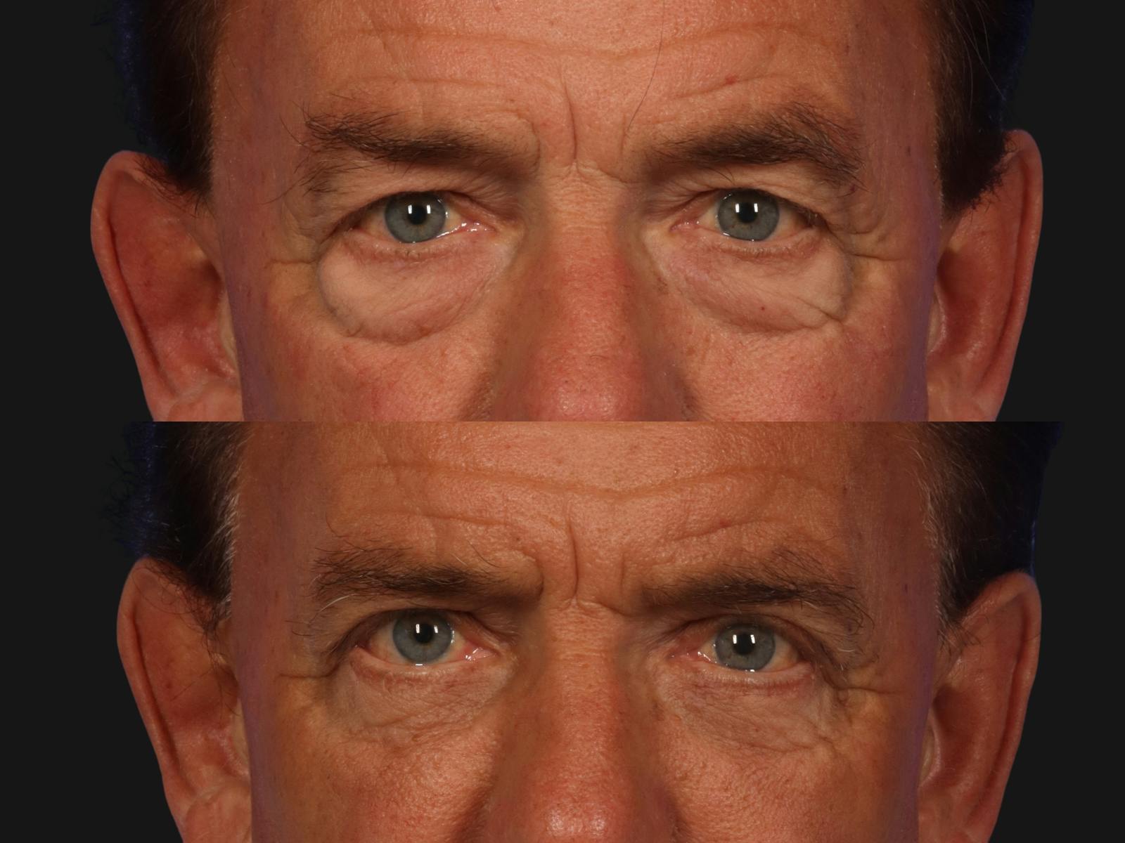 Blepharoplasty Before & After Gallery - Patient 859456 - Image 2