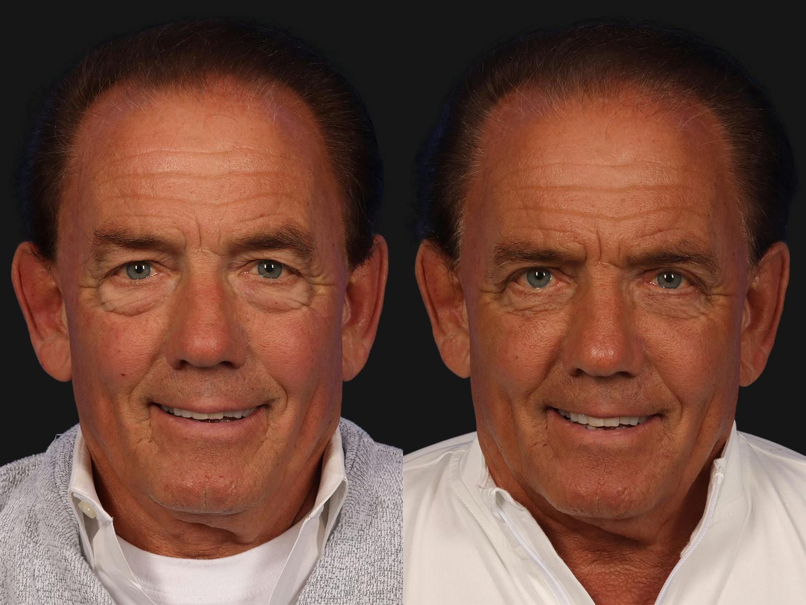 Blepharoplasty Before & After Gallery - Patient 859456 - Image 1