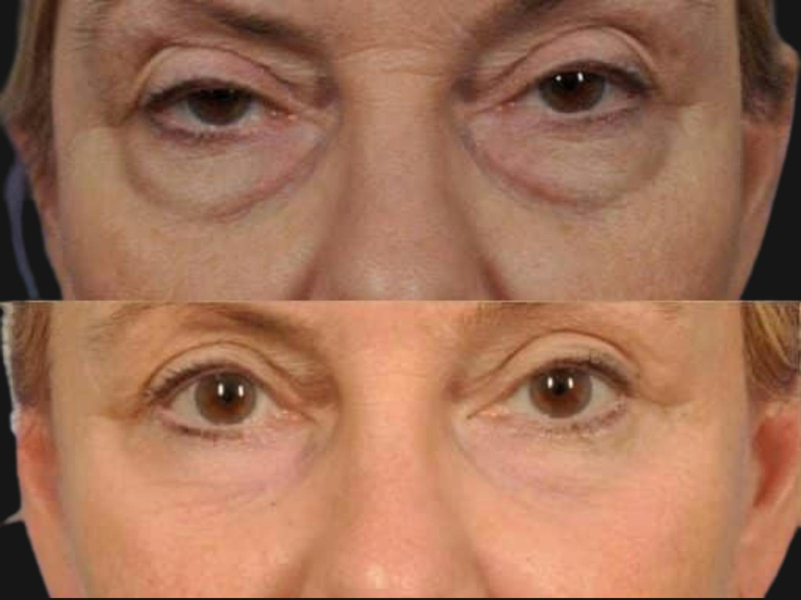 Blepharoplasty Before & After Gallery - Patient 243204 - Image 2