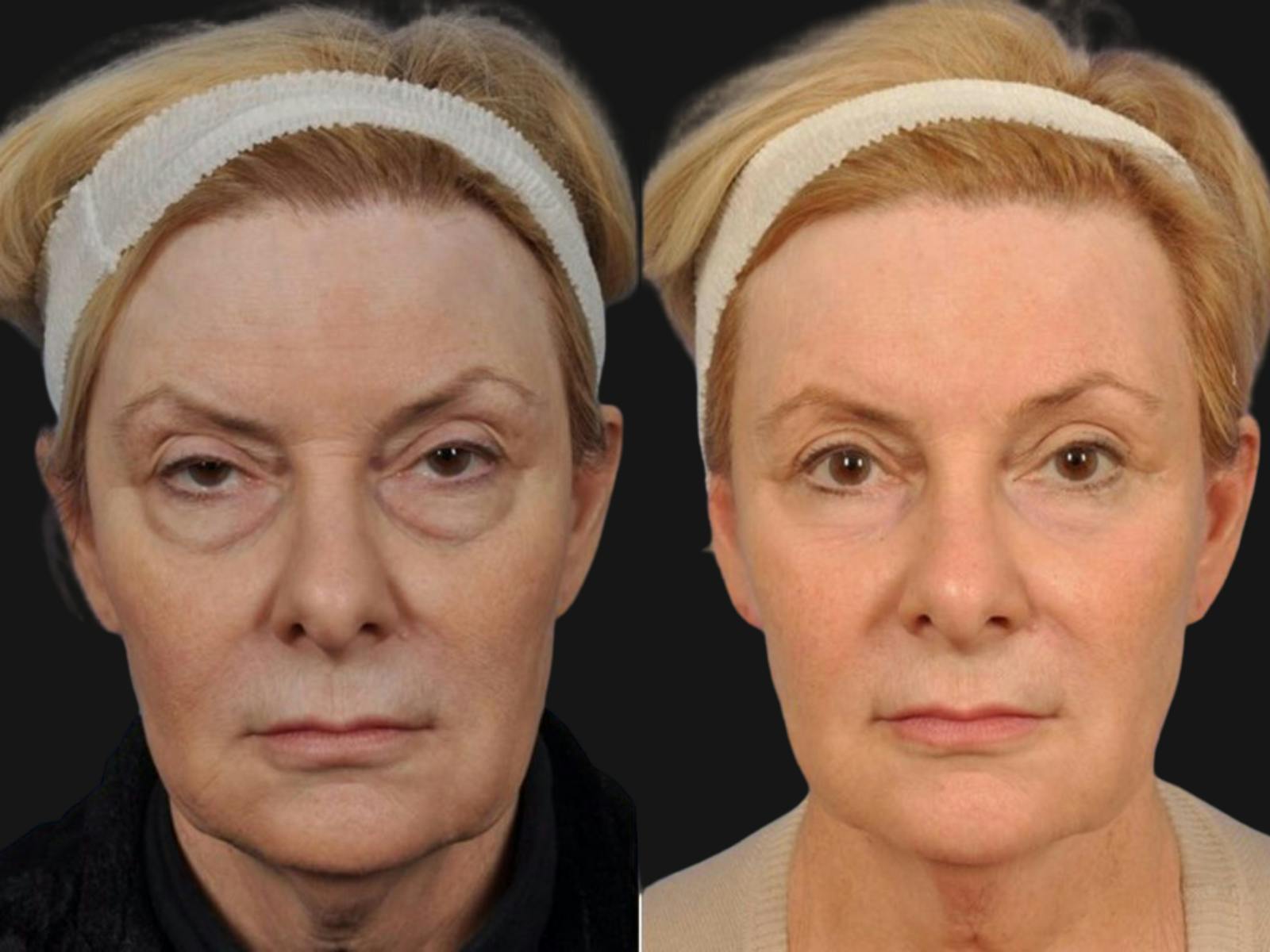 Blepharoplasty Before & After Gallery - Patient 243204 - Image 1