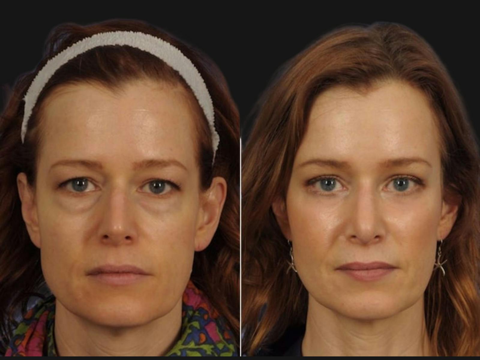 Blepharoplasty Before & After Gallery - Patient 394516 - Image 1