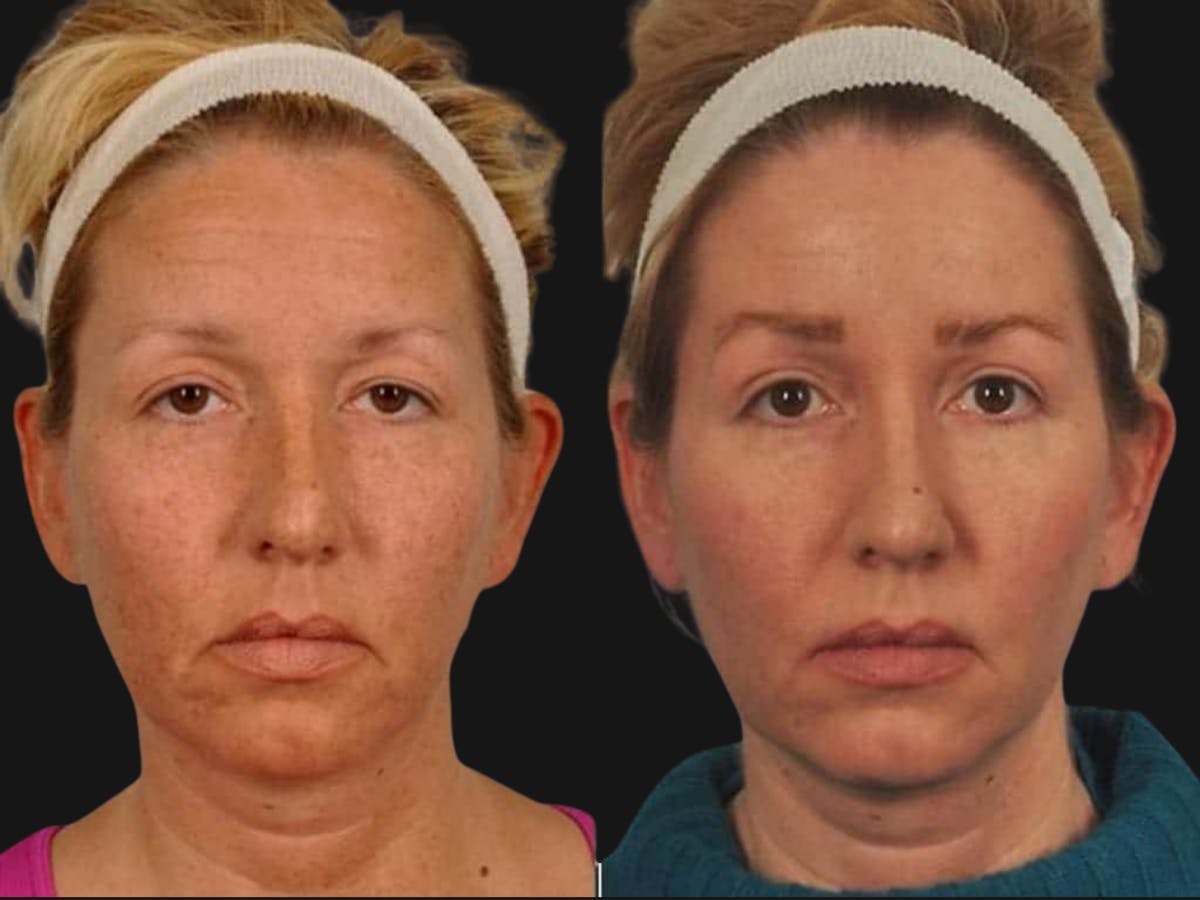 Blepharoplasty Before & After Gallery - Patient 615772 - Image 1