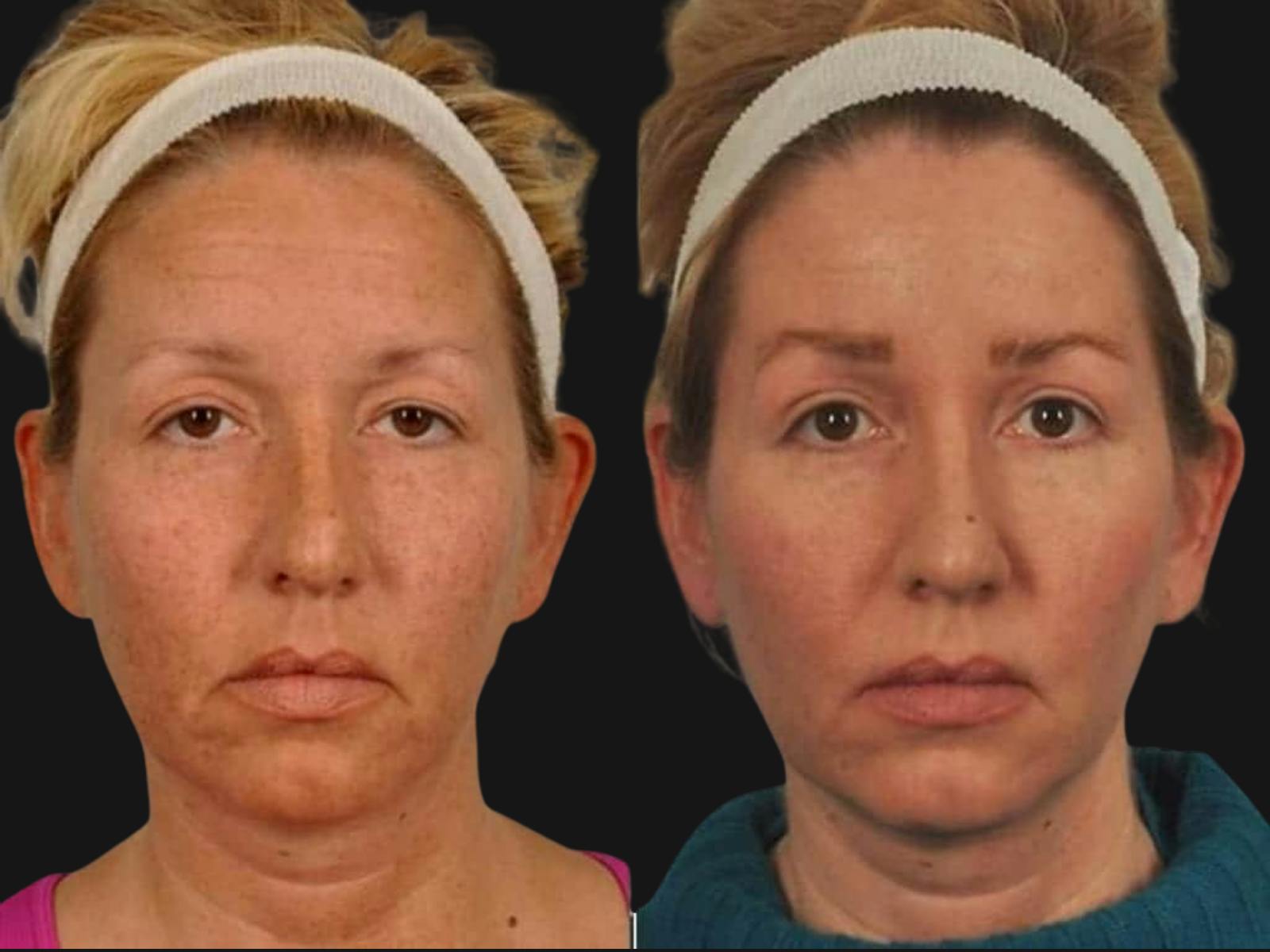 Blepharoplasty Before & After Gallery - Patient 615772 - Image 1