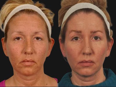 Blepharoplasty Before & After Gallery - Patient 615772 - Image 1