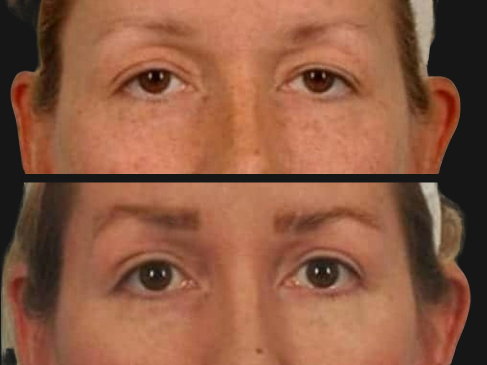Blepharoplasty Before & After Gallery - Patient 615772 - Image 2