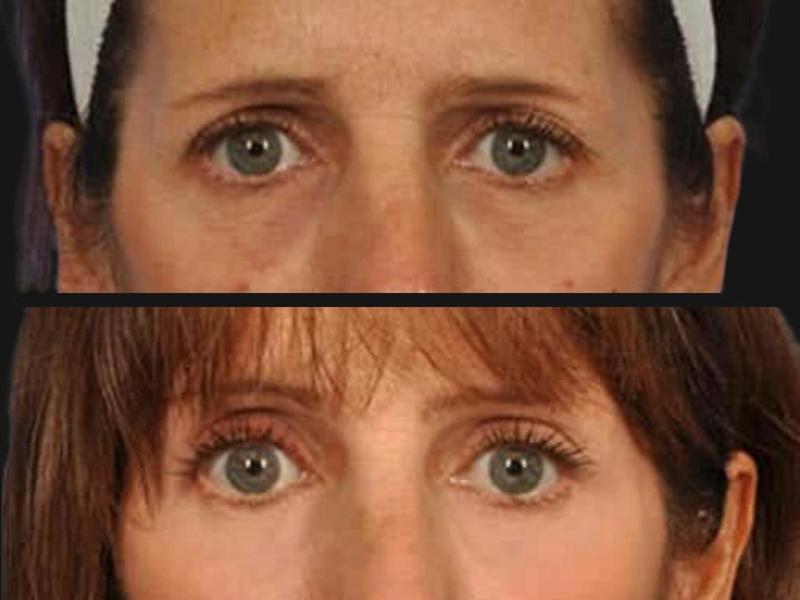 Blepharoplasty Before & After Gallery - Patient 275741 - Image 2