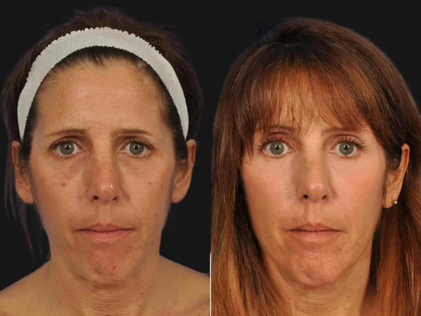Blepharoplasty Before & After Gallery - Patient 275741 - Image 1