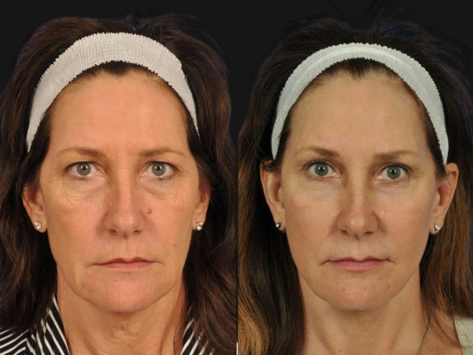 Blepharoplasty Before & After Gallery - Patient 290012 - Image 1