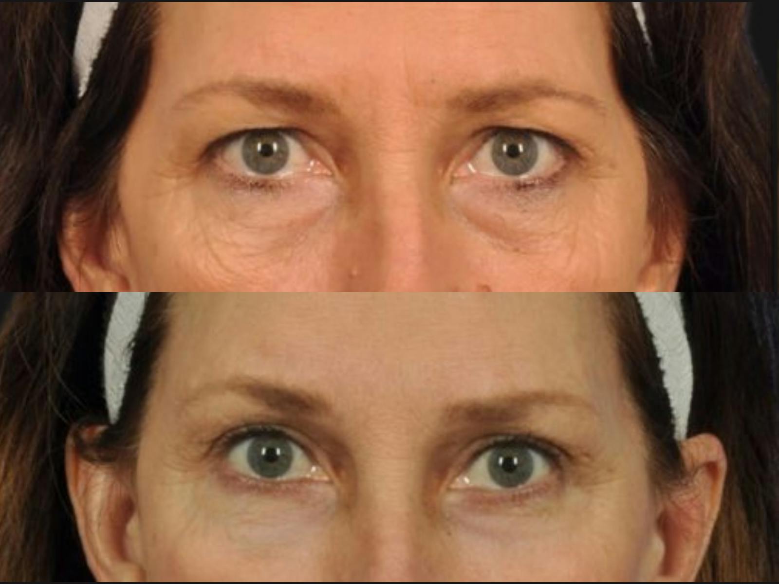 Blepharoplasty Before & After Gallery - Patient 290012 - Image 2