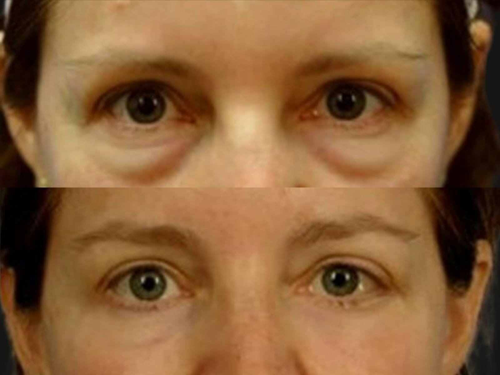 Blepharoplasty Before & After Gallery - Patient 360924 - Image 2