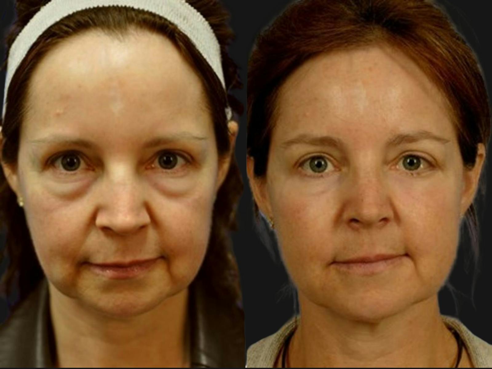 Blepharoplasty Before & After Gallery - Patient 360924 - Image 1