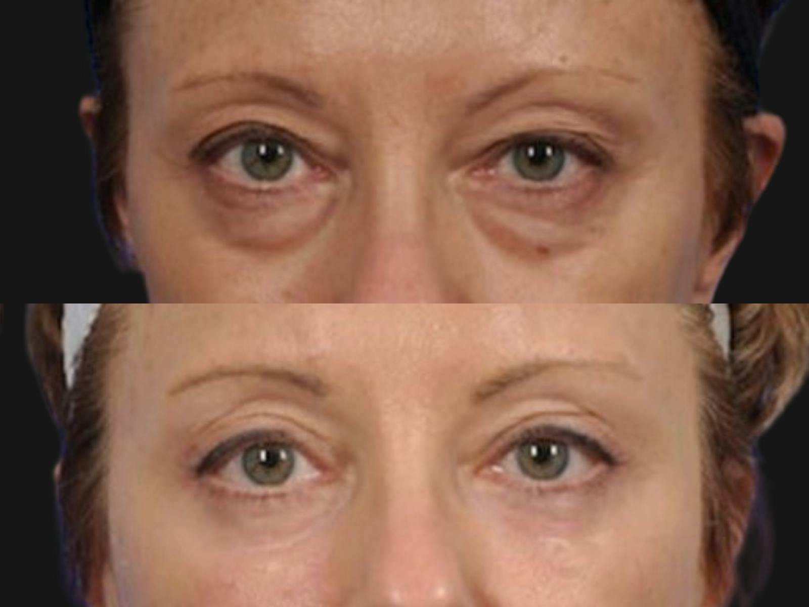 Blepharoplasty Before & After Gallery - Patient 132724 - Image 2