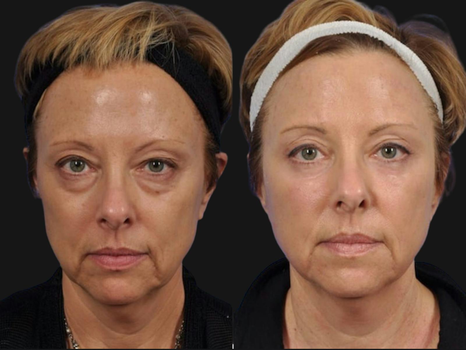 Blepharoplasty Before & After Gallery - Patient 132724 - Image 1