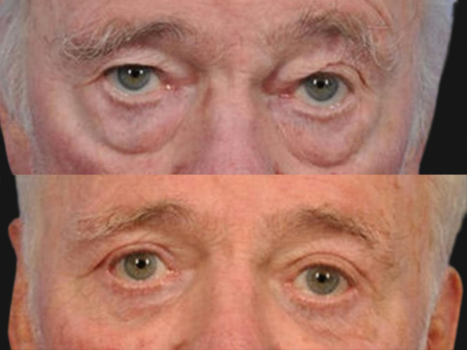 Blepharoplasty Before & After Gallery - Patient 414777 - Image 2